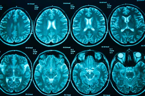 Diagnosing Brain Tumours While the Patient Is Still in Surgery?